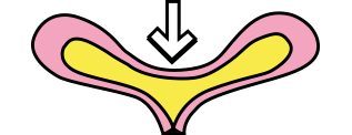 overactive bladder, bladder contracting