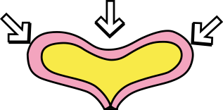 overactive bladder, bladder compression